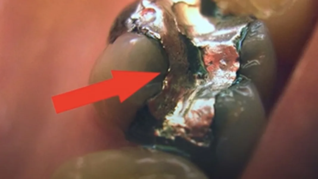 Health officials warn of mercury dental fillings in border clinics