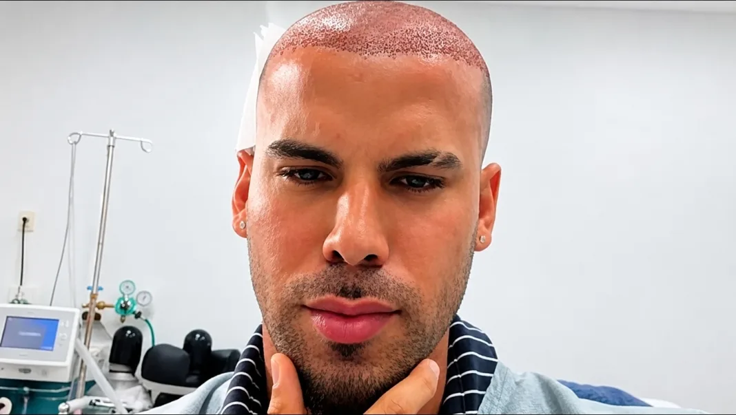Trinidad TikToker Takes Followers Inside His Hair Transplant: ‘Most Expensive Haircut’