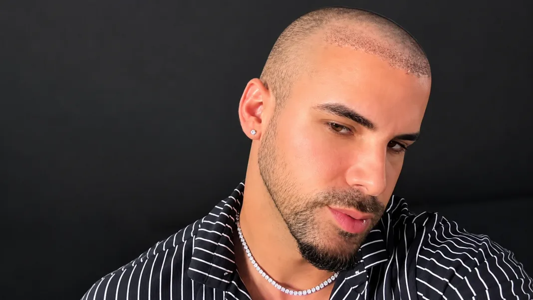 Alex Bebert Shares Day 5 Hair Transplant Update